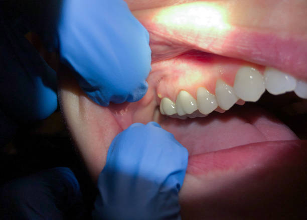 Best Emergency Dentist for Knocked-Out Tooth in Calhoun, GA